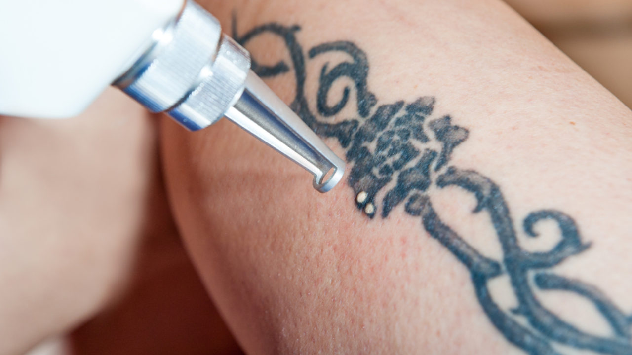 Invisible ink: the weird world of tattoo removal – in pictures | Art and  design | The Guardian