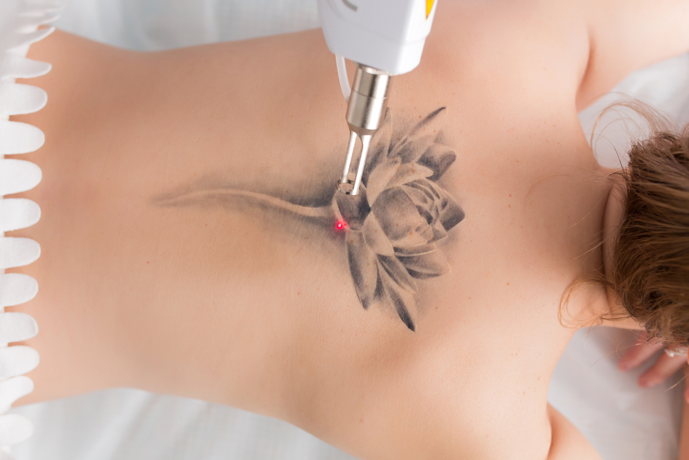Breakthrough for Tattoo Removal