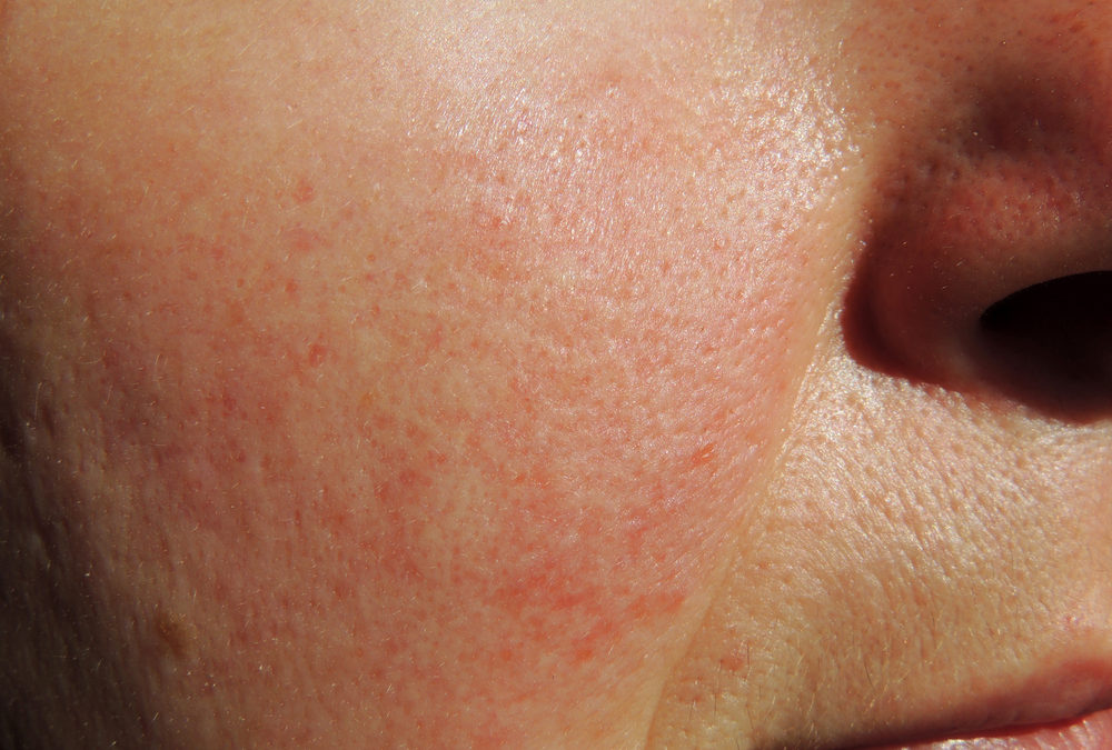 Rosacea: Best Treatment in Reston, VA