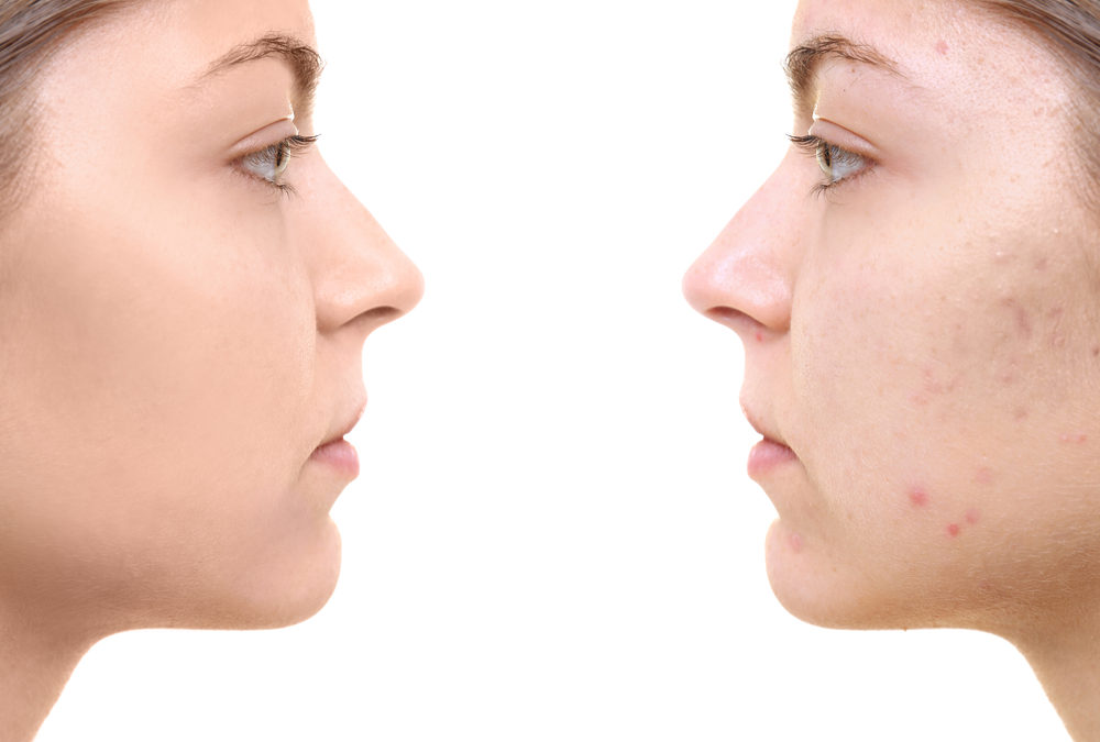 5 Common Types of Acne Scars: How Should You Get Rid of Them