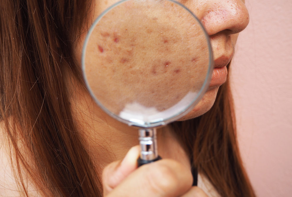 What are the Best Treatments for Acne Scars?
