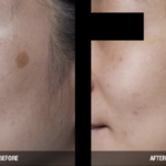 brown spot removal reston