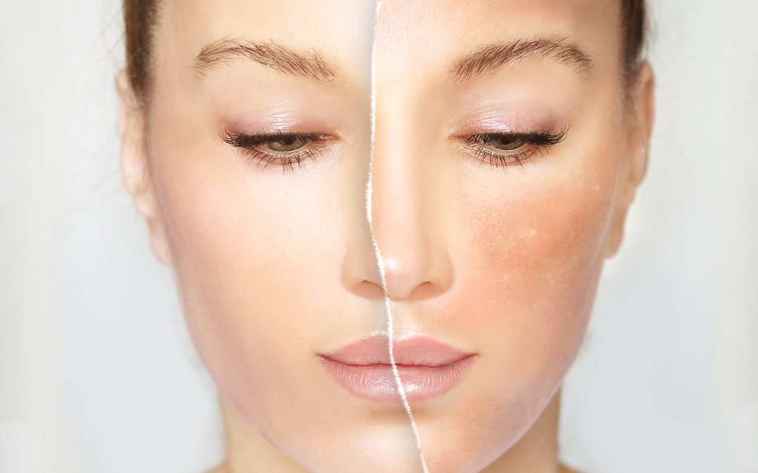 Reasons to See a Dermatologist for Uneven Skin Tone