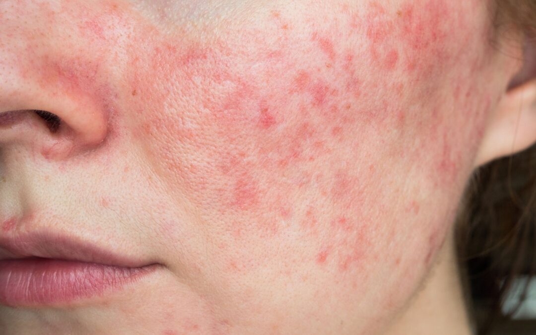 How to Treat Rosacea