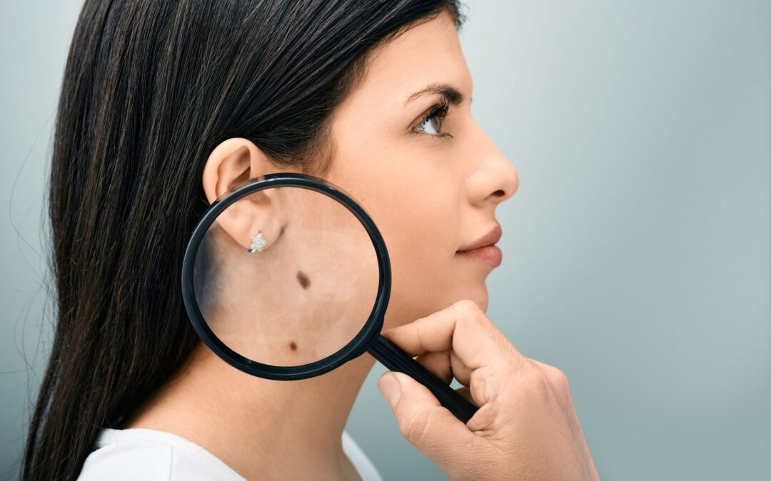 Skin Cancer Diagnosis?  Get Skin Cancer Treatment in Reston, VA