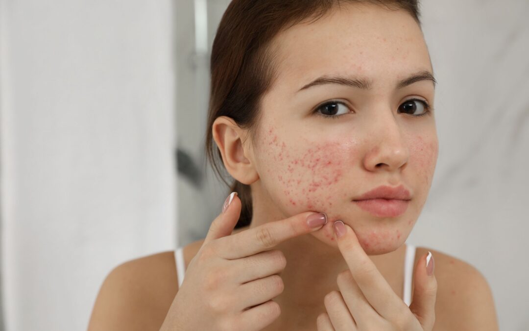 Dermatologist Recommendations for Teen Acne