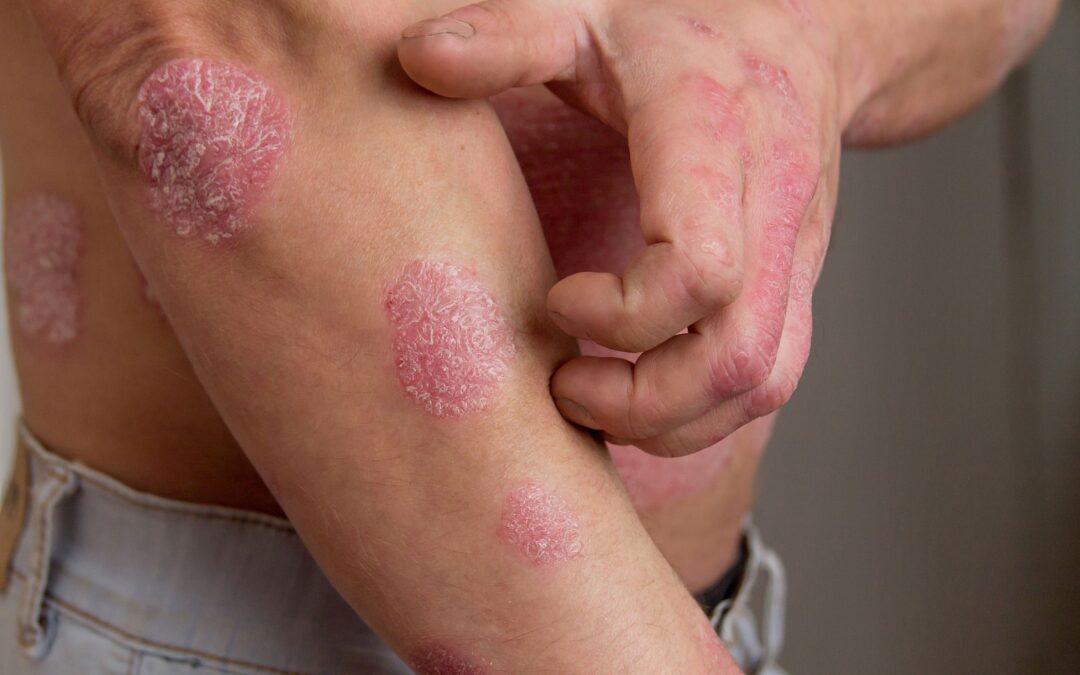 Get Help with Eczema – Northern Virginia Dermatology