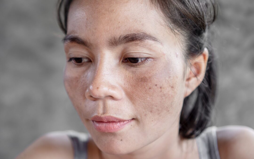 hyperpigmentation treatment in reston va