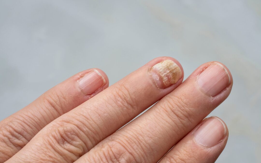 Nail Infection?  Get a Same Day Dermatology Appointment Near McLean, VA