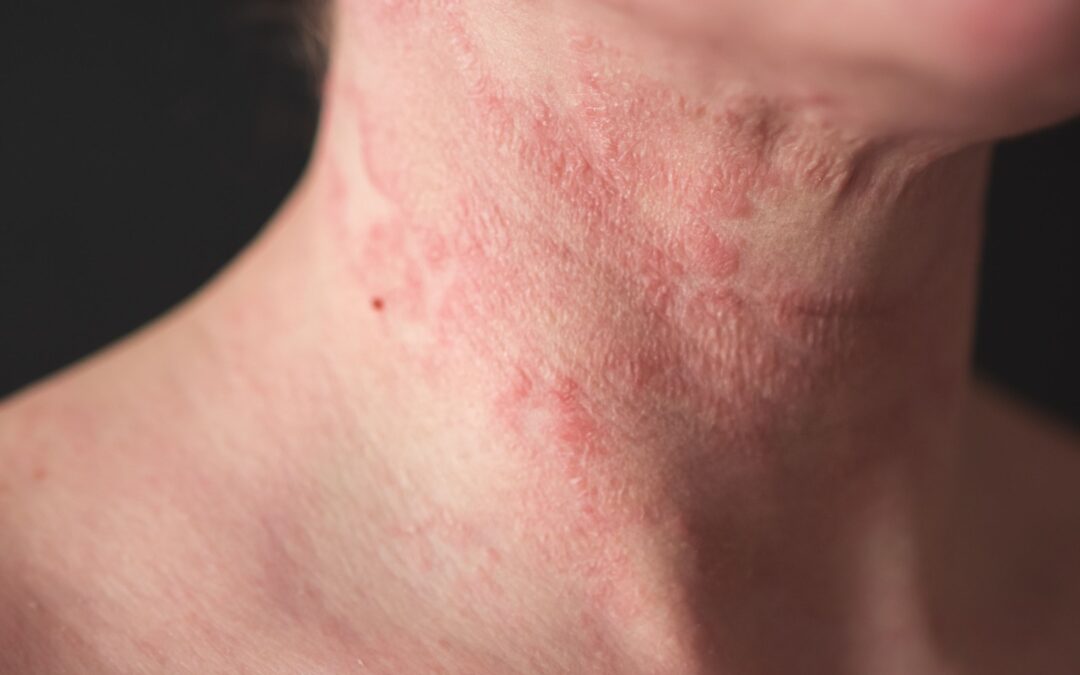 atopic dermatitis treatment in reston va