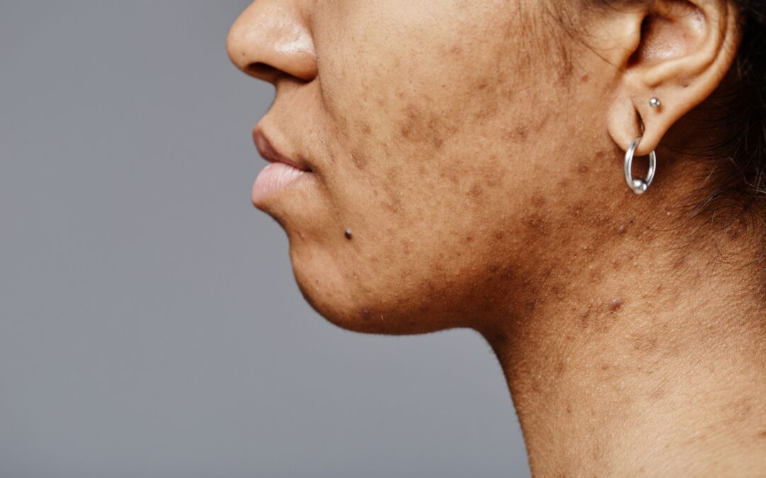 Get Acne Scar Treatment in Herndon, VA