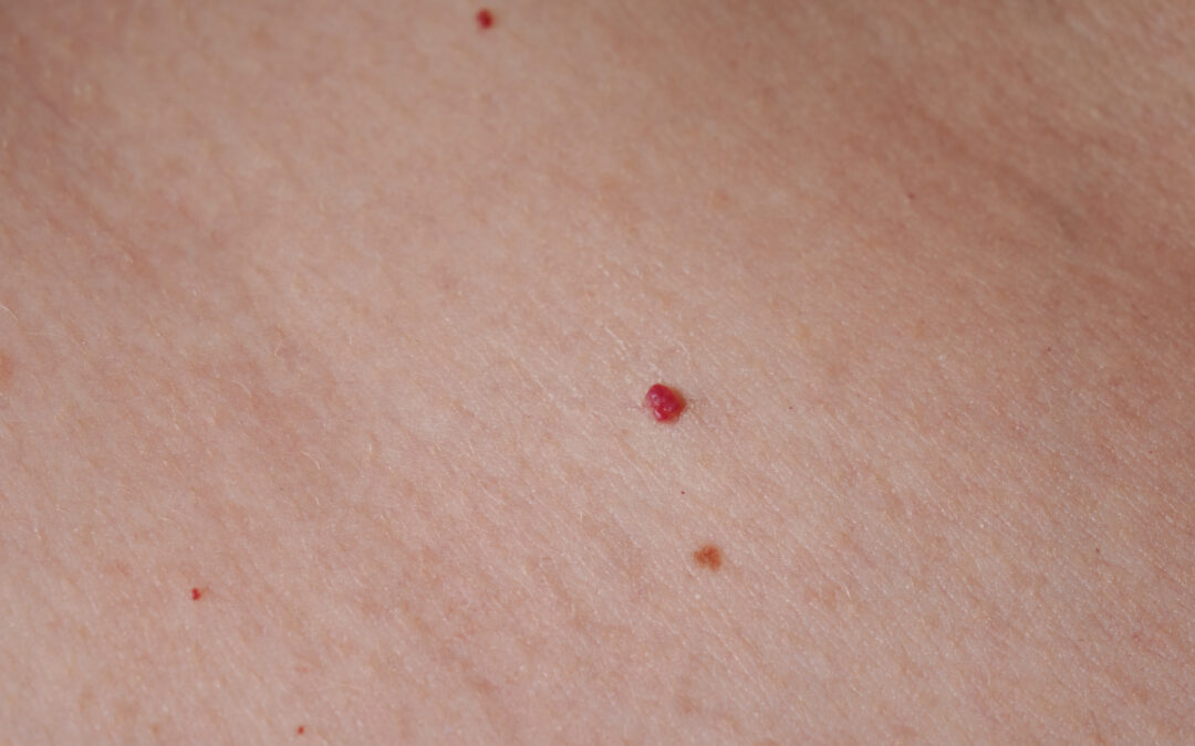 Effective Cherry Angioma Treatment Options for Clearer Skin
