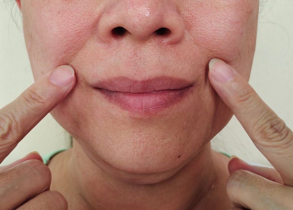 Botox vs. Dermal Fillers for Marionette Lines