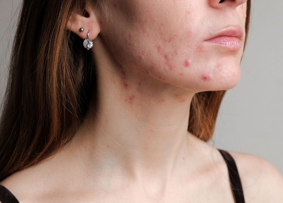 Derm Reston - Hormone Acne Specialist in Reston, VA