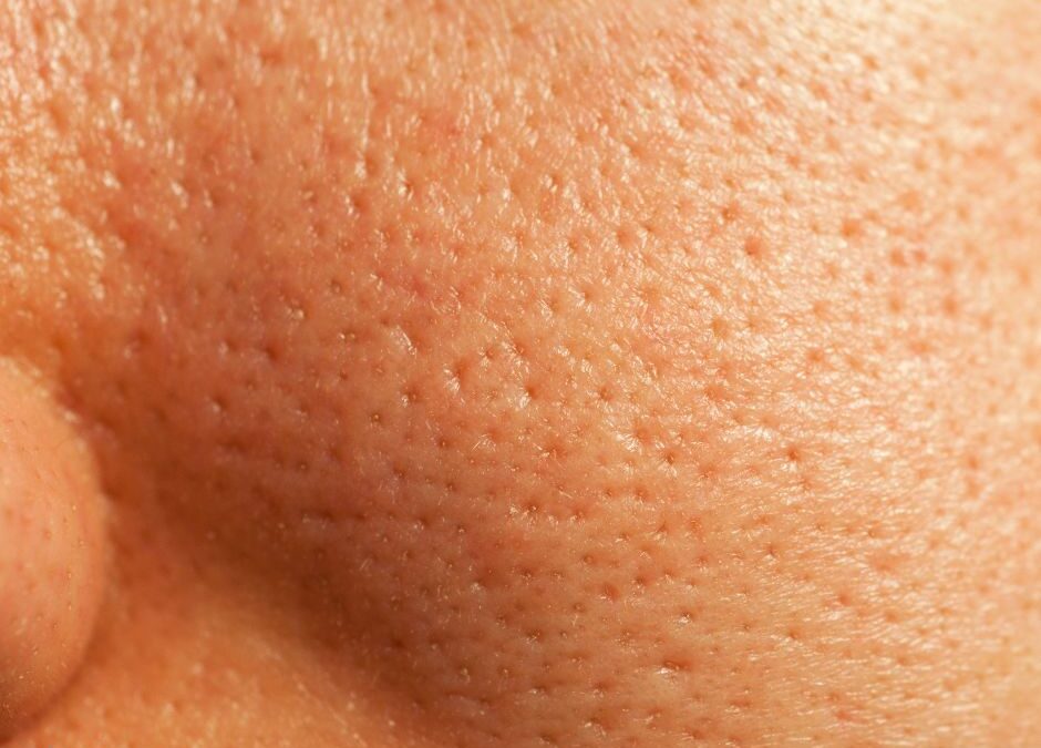 Derm Reston - Microneedling in Reston VA